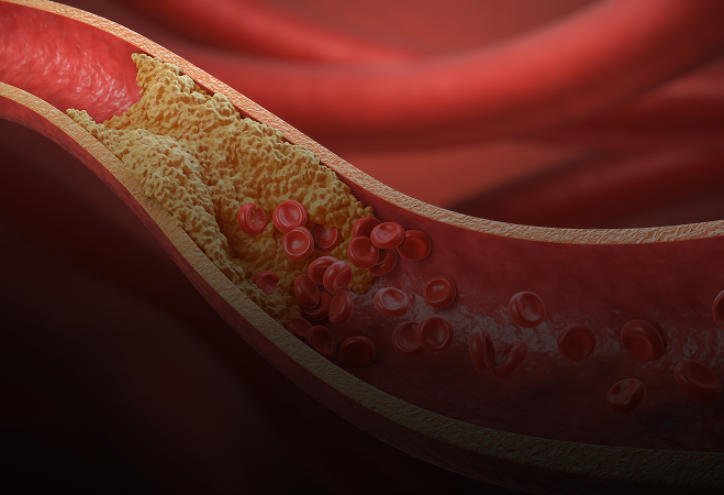 Impact of the ApoE Genotype on Coronary Artery Disease and the Incidence of Myocardial Infarction: A Clinical Observational Study